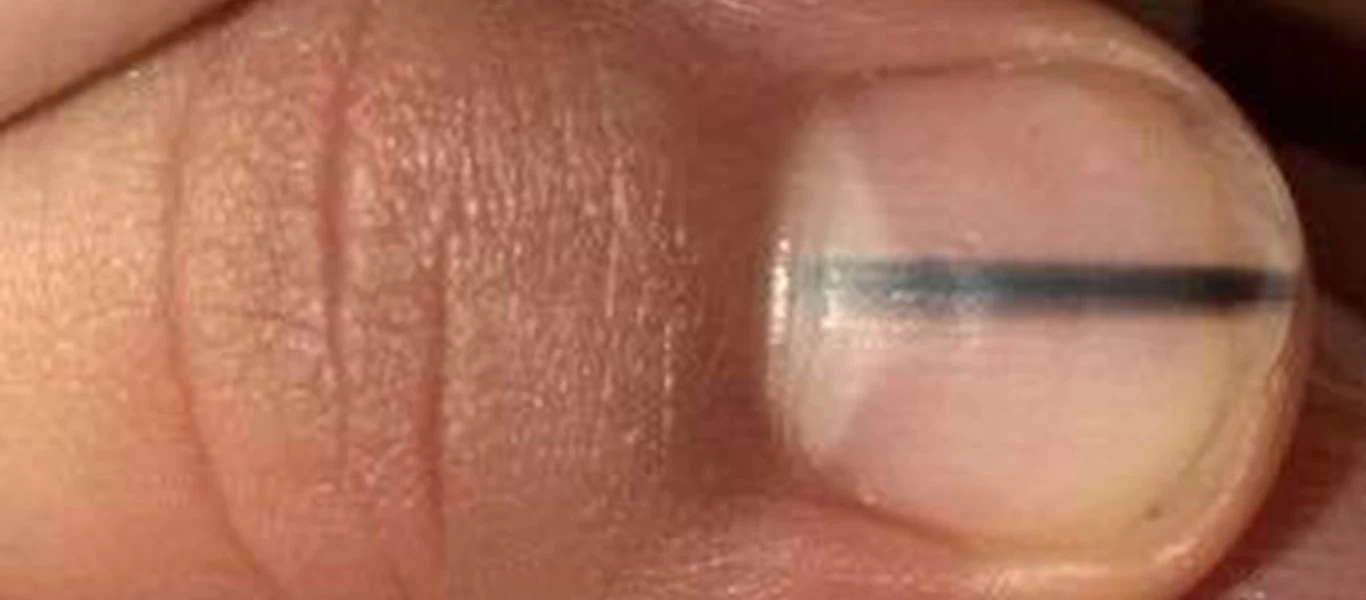 Τι σημαίνει αν δείτε αυτό το σημάδι στο νύχι σας